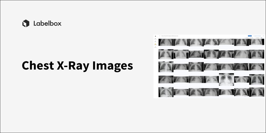 chest-x-ray-images